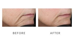 before and after images. Before has sagging face skin and after has less wrinkles and more skin lift.