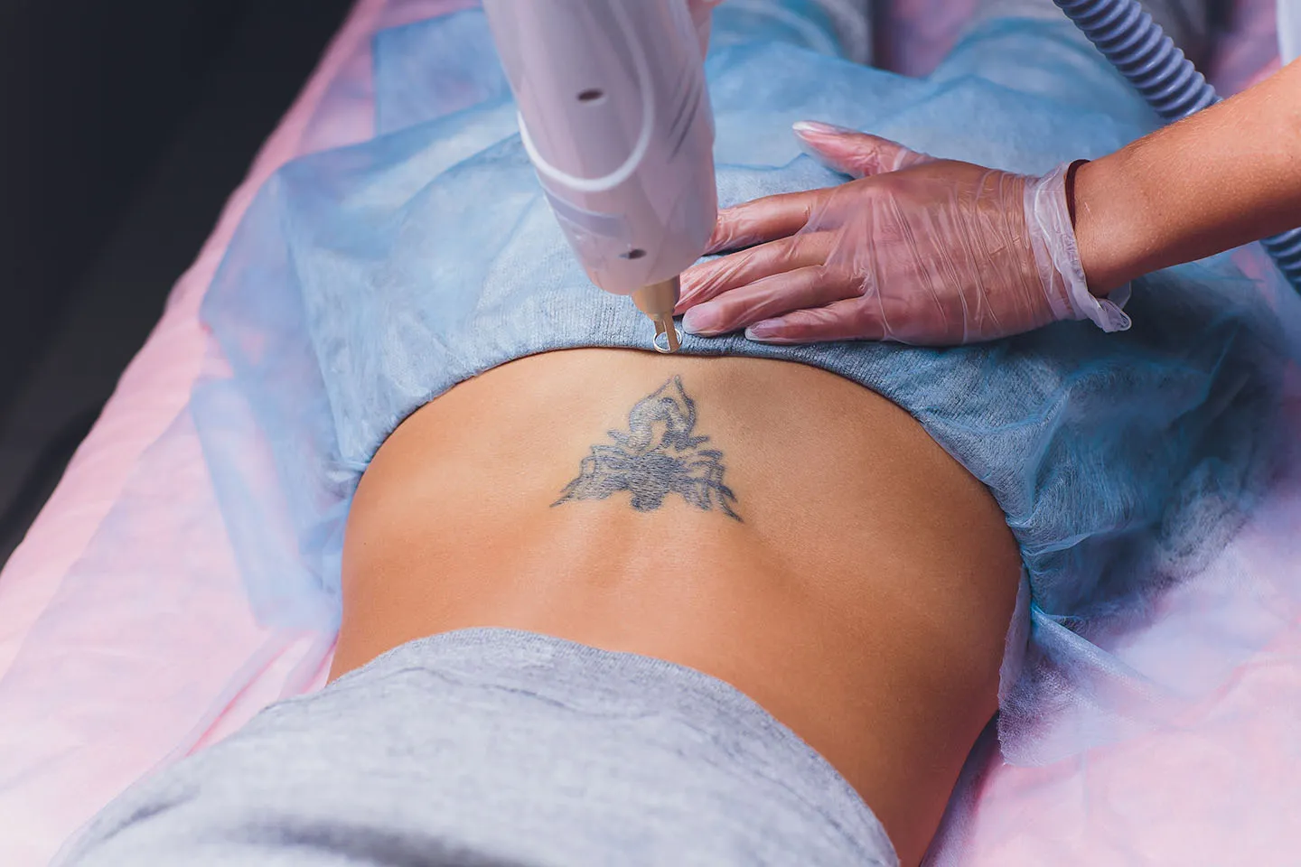 Tattoo Removal - Face Facts Beauty & Skin Clinic