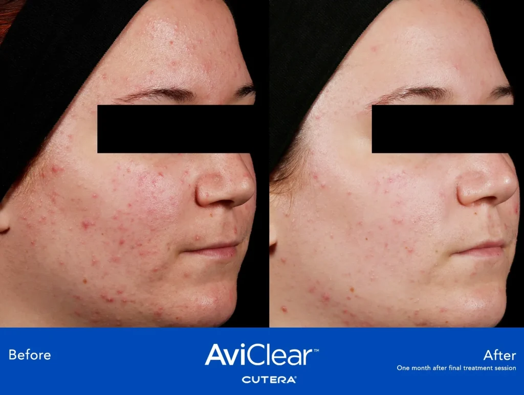 AviClear acne treatment before and after.
