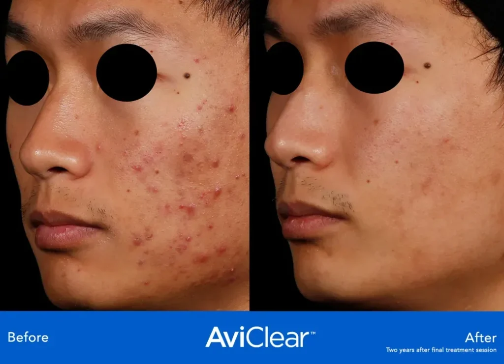 Acne treatment AviClear before and after.