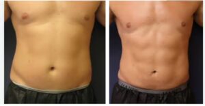 Before and After of a male following EmSculpt NEO Treatments at Xanadu Med Spa